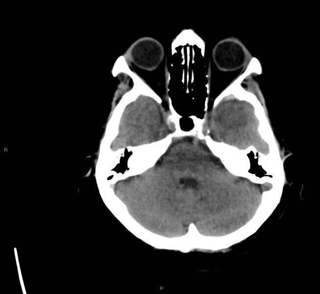 File:Cerebral amyloid angiopathy-associated lobar intracerebral hemorrhage (Radiopaedia 58561-65724 Axial non-contrast 35).jpg