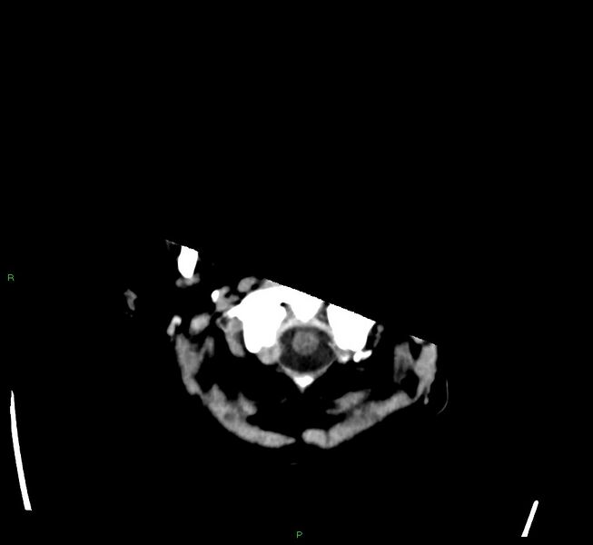File:Cerebral amyloid angiopathy-associated lobar intracerebral hemorrhage (Radiopaedia 58563-65727 Axial non-contrast 51).jpg