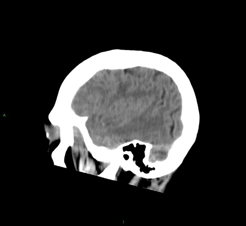 Cerebral amyloid angiopathy-associated lobar intracerebral hemorrhage (Radiopaedia 58752-65973 C 13).jpg