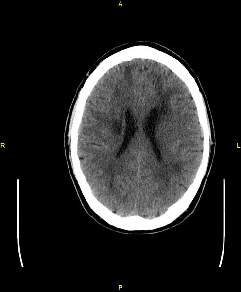 File:Cerebral autosomal dominant arteriopathy with subcortical infarcts and leukoencephalopathy (CADASIL) (Radiopaedia 86108-102051 Axial non-contrast 69).jpg