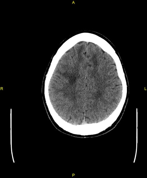 File:Cerebral autosomal dominant arteriopathy with subcortical infarcts and leukoencephalopathy (CADASIL) (Radiopaedia 86108-102051 Axial non-contrast 83).jpg