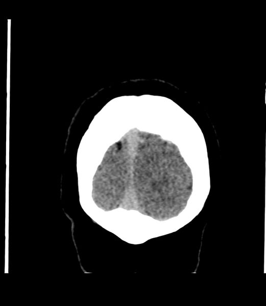 File:Cerebral dural venous sinus thrombosis (Radiopaedia 86514-102575 Coronal non-contrast 52).jpg