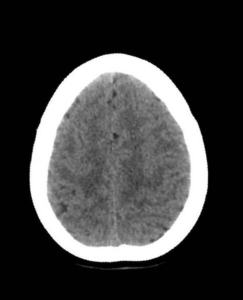 File:Cerebral edema due to severe hyponatremia (Radiopaedia 89826-106938 Axial non-contrast 83).jpg