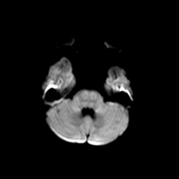 File:Cerebral tuberculoma (Radiopaedia 41152-43932 Axial DWI 4).jpg