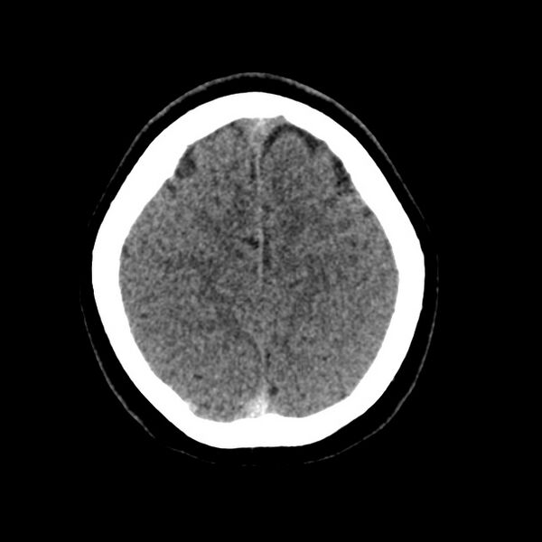 File:Cerebral venous sinus thrombosis (Radiopaedia 59224-66551 Axial non-contrast 39).jpg