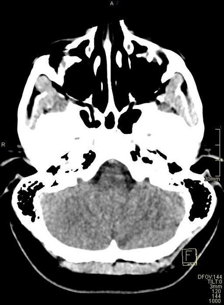 File:Cerebral venous sinus thrombosis (Radiopaedia 91329-108965 Axial non-contrast 10).jpg
