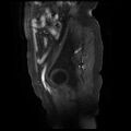 Cervical carcinoma (Radiopaedia 78847-91705 I 1).jpg