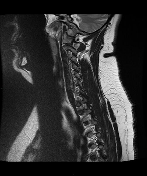 File:Cervical disc prolapse (Radiopaedia 80258-93598 Sagittal T2 3).jpg