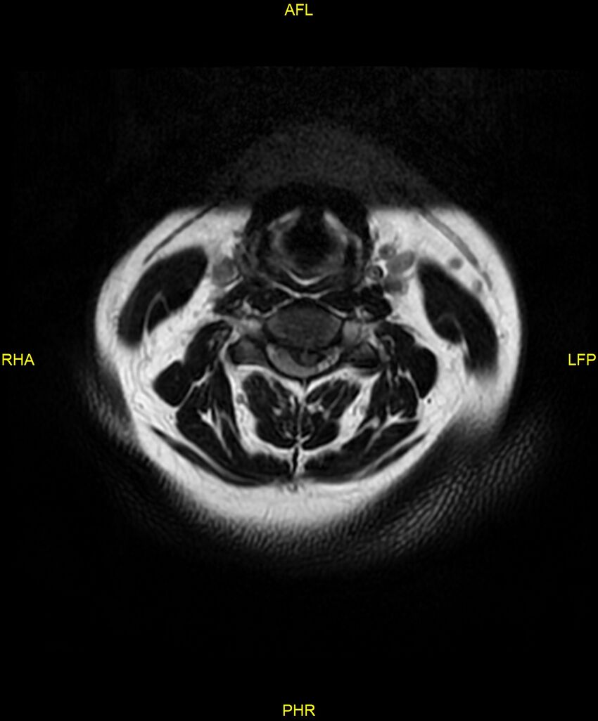 Cervical disc protrusion (Radiopaedia 87147-103415 Axial T2 11).jpg