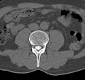 Cervical dural CSF leak on MRI and CT treated by blood patch (Radiopaedia 49748-54996 B 104).png