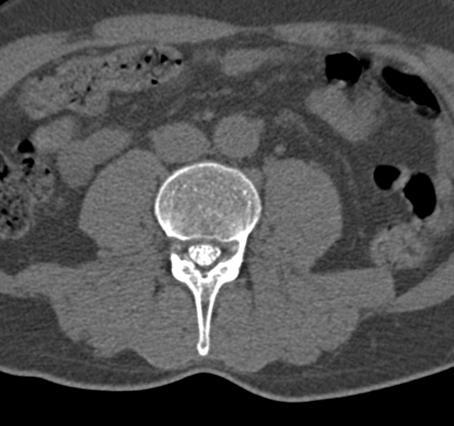 File:Cervical dural CSF leak on MRI and CT treated by blood patch (Radiopaedia 49748-54996 B 104).png