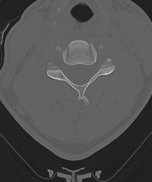 File:Cervical intercalary bone (Radiopaedia 35211-36748 Axial bone window 34).png