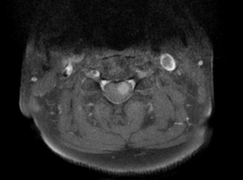 File:Cervical schwannoma (Radiopaedia 72399-82934 Axial T1 C+ fat sat 6).jpg