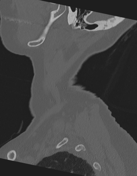 File:Cervical spine ACDF loosening (Radiopaedia 48998-54071 Sagittal bone window 11).png