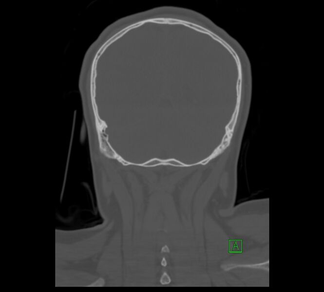 File:Cervical spine fracture - hyperflexion injury (Radiopaedia 66184-75364 Coronal bone window 17).jpg