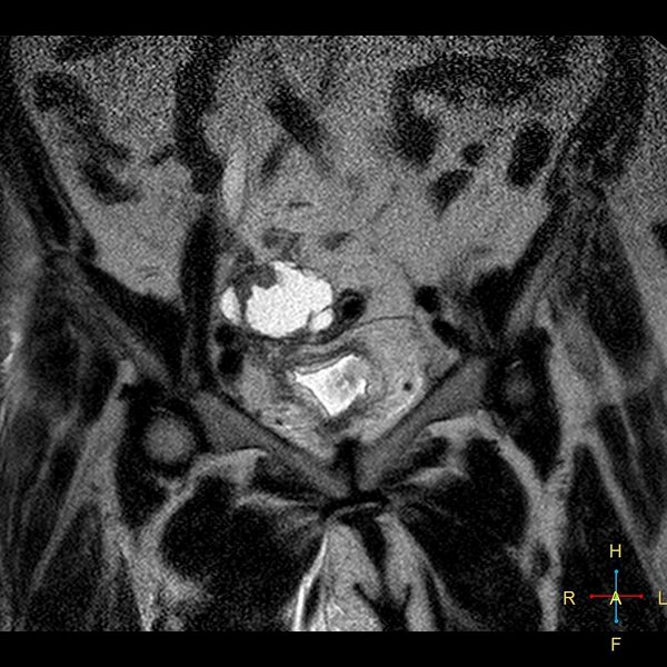 File:Cervical stump squamous cell carcinoma (Radiopaedia 48049-52858 Coronal T2 3).jpg