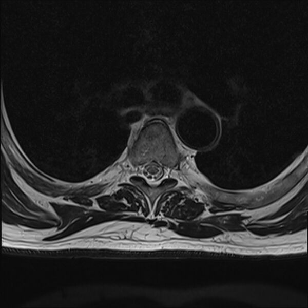 File:Cervical tumor-like myelopathy due to Type V dAVF (Radiopaedia 82461-96604 D 15).jpg