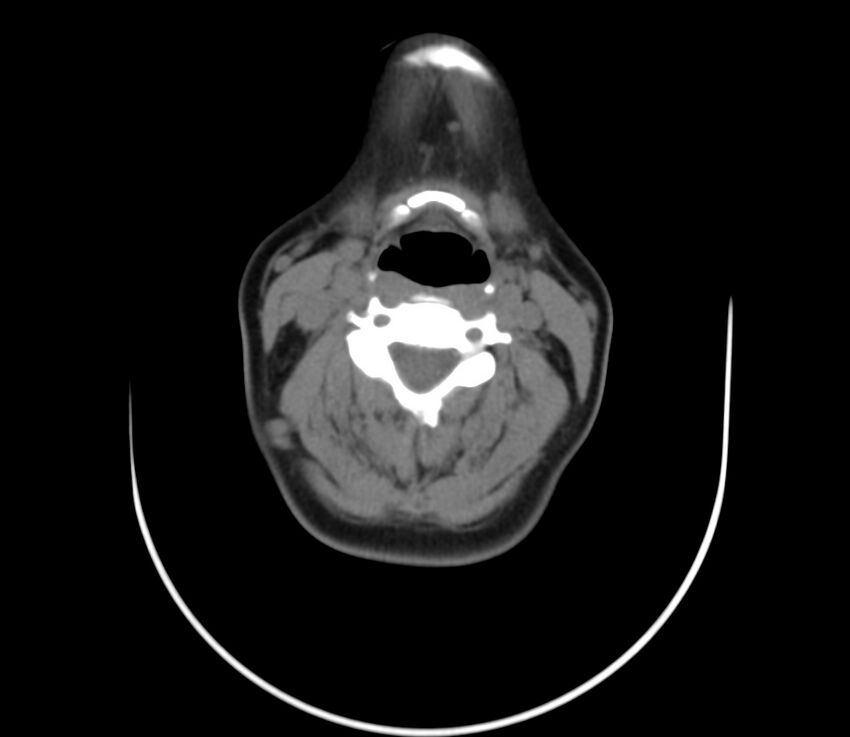Cervical venous malformation (Radiopaedia 22653-22672 Axial non-contrast 32).jpg