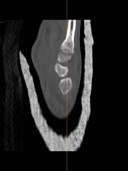 File:Chauffeur's (Hutchinson) fracture (Radiopaedia 58043-65079 Sagittal bone window 15).jpg