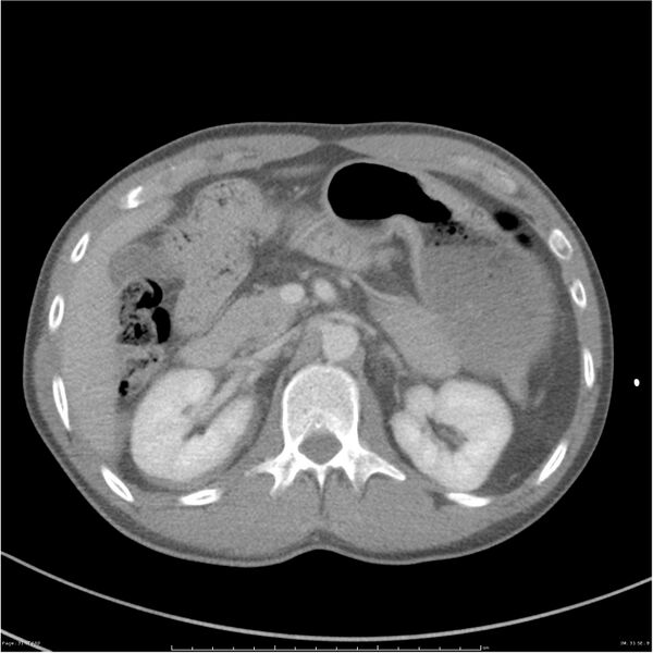 File:Chest and abdomen multi-trauma (Radiopaedia 26294-26426 bone window 31).jpg