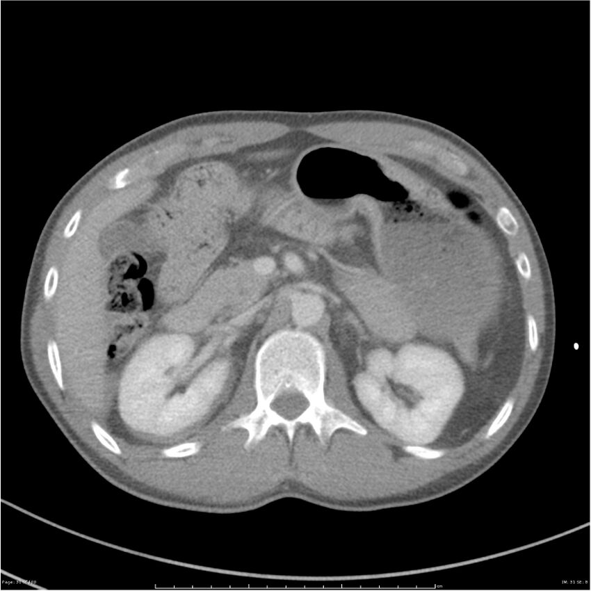 Chest and abdomen multi-trauma (Radiopaedia 26294-26426 bone window 31).jpg