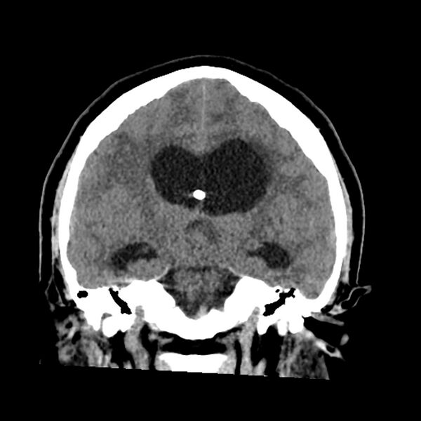 File:Chiasmatic-hypothalamic juvenile pilocytic astrocytoma (Radiopaedia 78533-91237 Coronal non-contrast 37).jpg