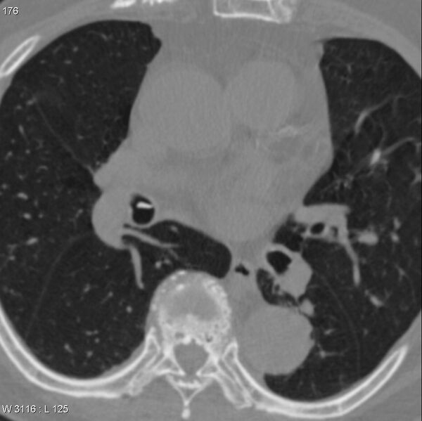 File:Chicken bone in bronchus (Radiopaedia 6550-7861 Axial lung window 3).jpg
