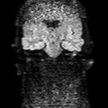 Cholesteatoma (Radiopaedia 10742-11204 Coronal DWI 9).jpg