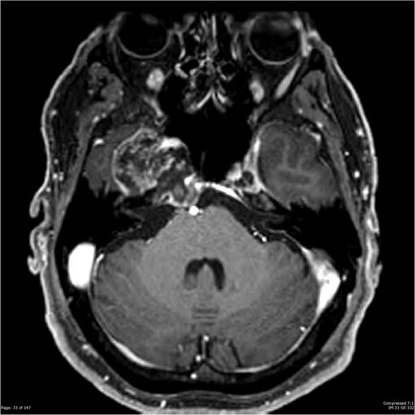 File:Chondrosarcoma of skull base- grade II (Radiopaedia 40948-43654 Axial T1 C+ 21).jpg
