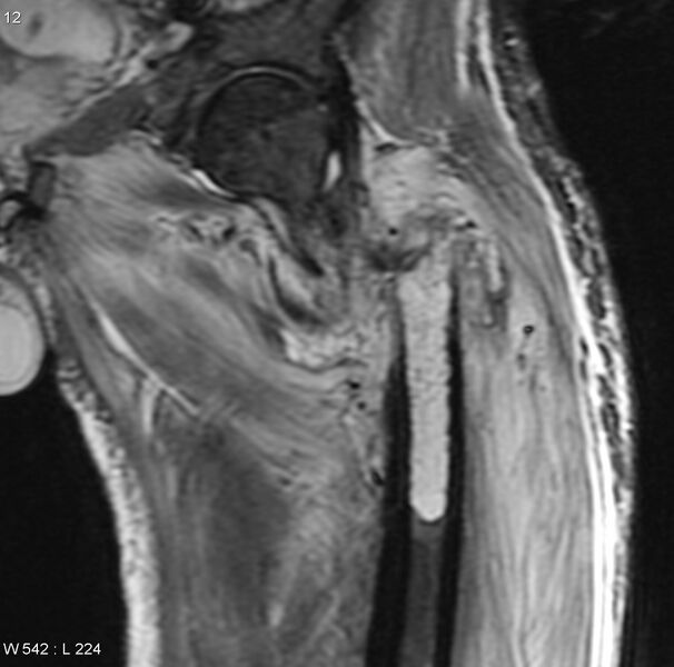 File:Chondrosarcoma with pathological fracture - femur (Radiopaedia 6174-7629 Coronal STIR 3).jpg