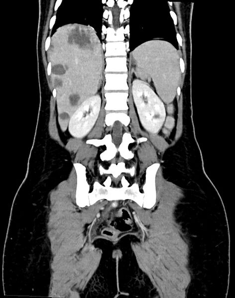 File:Choriocarcinoma liver metastases (Radiopaedia 74768-85766 B 74).jpg