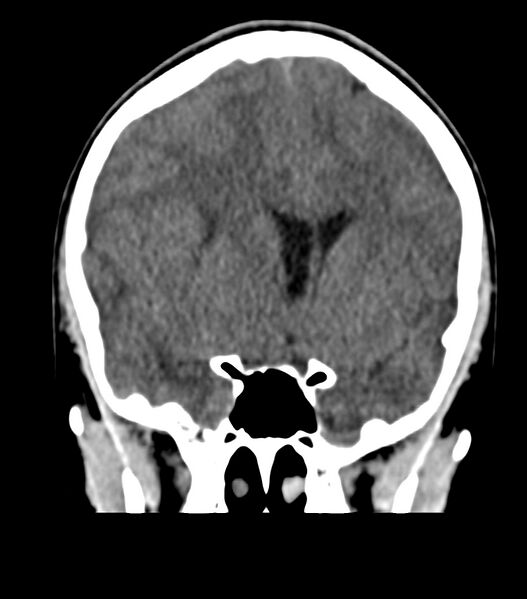 File:Choroid plexus carcinoma (Radiopaedia 91013-108552 Coronal non-contrast 33).jpg
