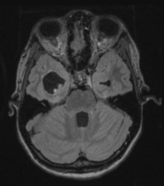 File:Choroid plexus carcinoma (Radiopaedia 91013-108553 Axial FLAIR C+ 104).jpg