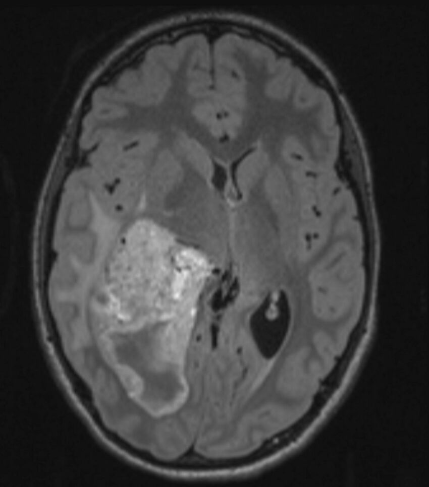 Choroid plexus carcinoma (Radiopaedia 91013-108553 Axial FLAIR C+ 131).jpg