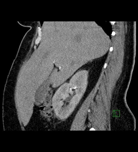 File:Chromophobe renal cell carcinoma (Radiopaedia 84239-99519 D 79).jpg