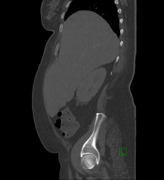 File:Chromophobe renal cell carcinoma (Radiopaedia 84239-99519 Sagittal bone window 83).jpg