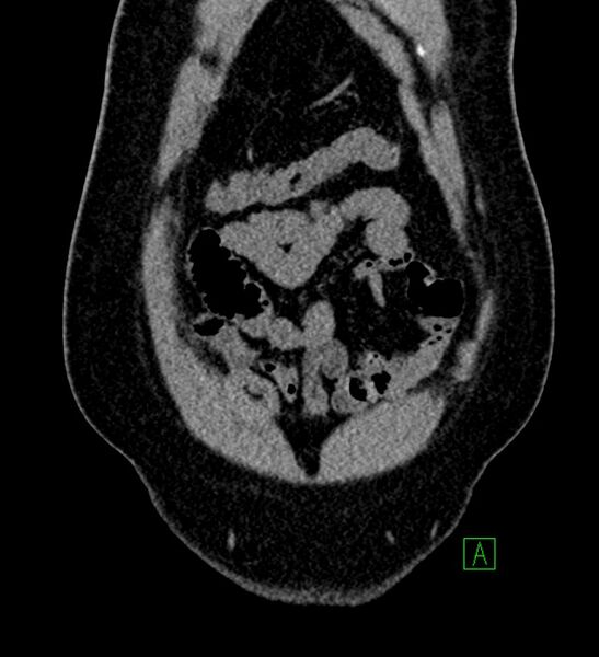 File:Chromophobe renal cell carcinoma (Radiopaedia 84286-99573 Coronal non-contrast 22).jpg