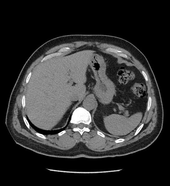File:Chromophobe renal cell carcinoma (Radiopaedia 86879-103083 Axial non-contrast 11).jpg