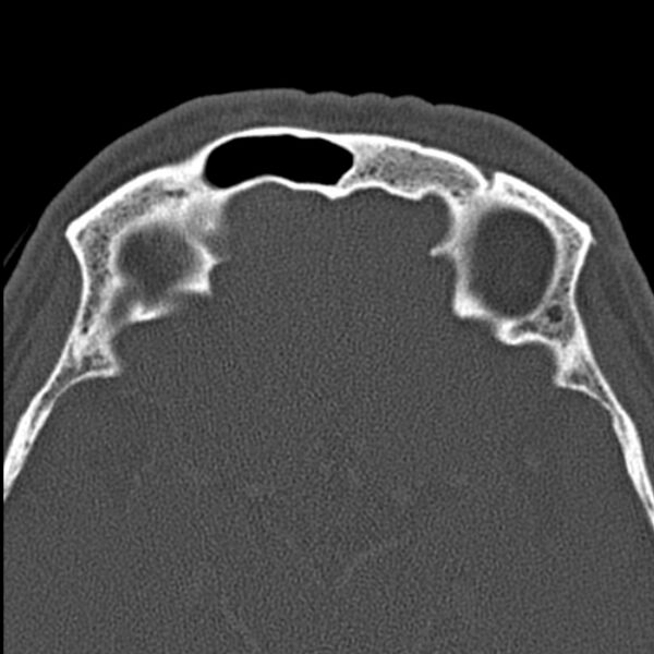 File:Chronic maxillary sinusitis (Radiopaedia 27879-28116 Axial bone window 46).jpg