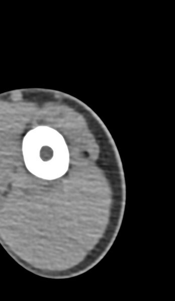 File:Chronic osteomyelitis of the distal humerus (Radiopaedia 78351-90971 Axial 252).jpg