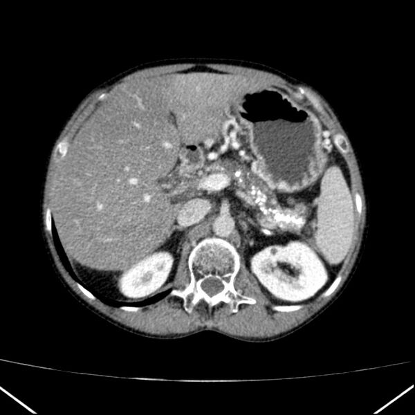 File:Chronic pancreatitis (Radiopaedia 23132-23172 B 18).jpg