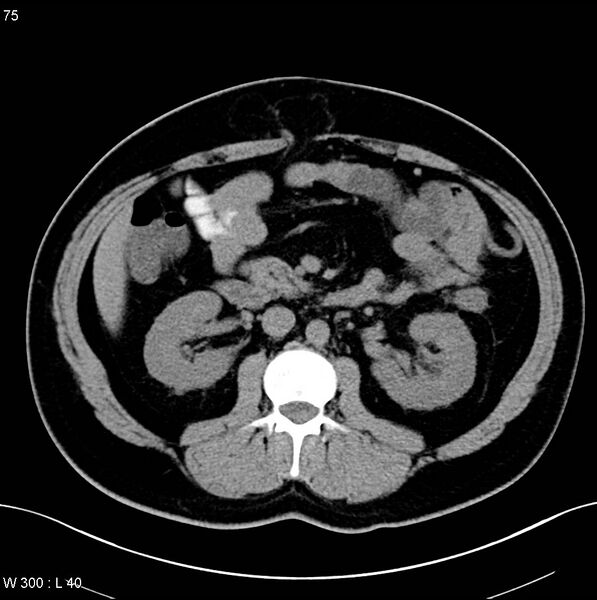 File:Chronic pancreatitis and pseudocysts (Radiopaedia 6724-7935 Axial non-contrast 15).jpg