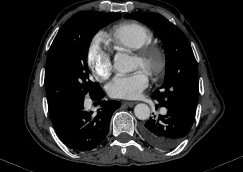 File:Chronic pulmonary embolism with bubbly consolidation (Radiopaedia 91248-108850 C+ arterial phase 89).jpg