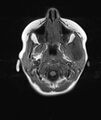 Chronic reactive multifocal osteomyelitis (CRMO) - mandible (Radiopaedia 56405-63069 Axial T1 17).jpg