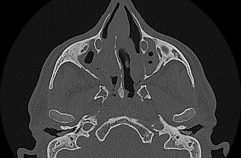 File:Chronic rhinosinusitis (Radiopaedia 65079-74075 Axial bone window 31).jpg