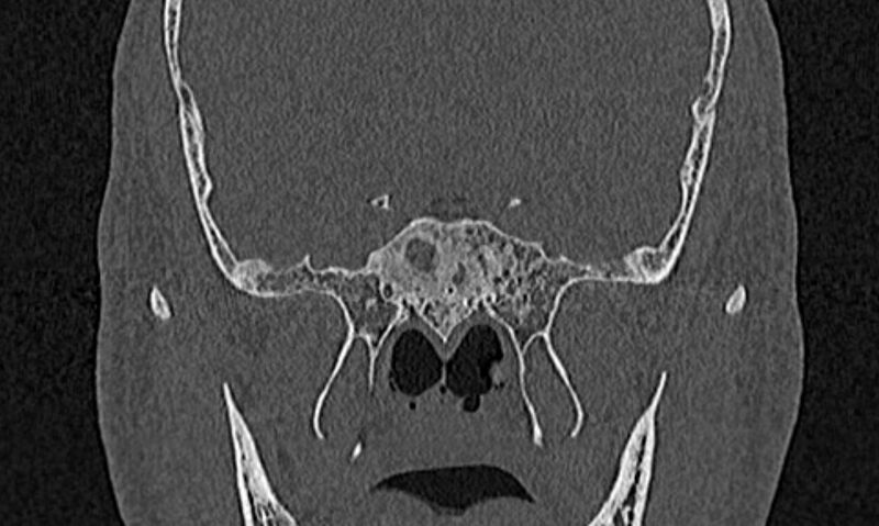 File:Chronic rhinosinusitis (Radiopaedia 65079-74075 Coronal bone window 72).jpg