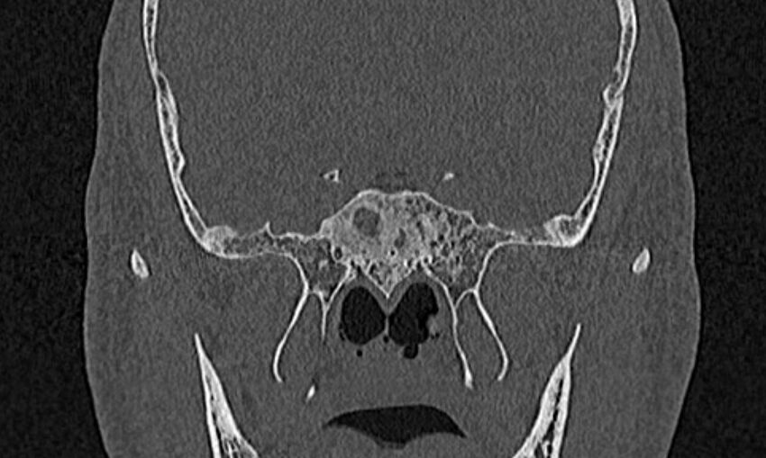 Chronic rhinosinusitis (Radiopaedia 65079-74075 Coronal bone window 72).jpg