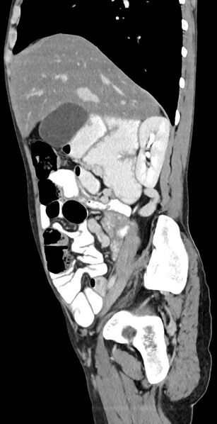 File:Chronic small bowel volvulus (Radiopaedia 75224-86322 C 99).jpg