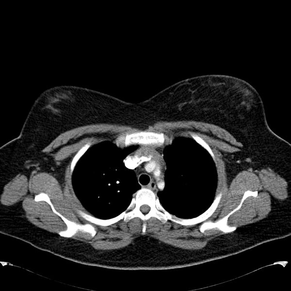 File:Chronic thromboembolic pulmonary hypertension (CTEPH) (Radiopaedia 74597-85531 Axial C+ CTPA 13).jpg