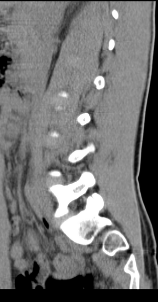File:Clear cell meningoma - lumbar spine (Radiopaedia 60116-67691 A 31).png